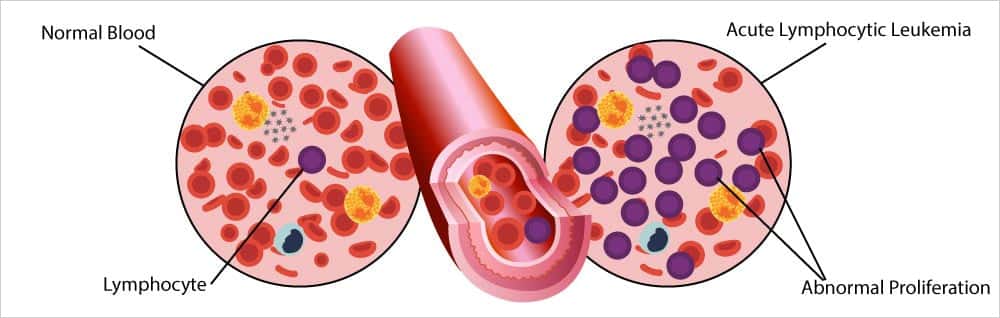 Acute Lymphocytic Leukemia (ALL)