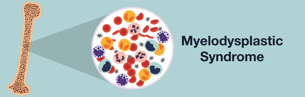 Myelodysplastic Syndrome